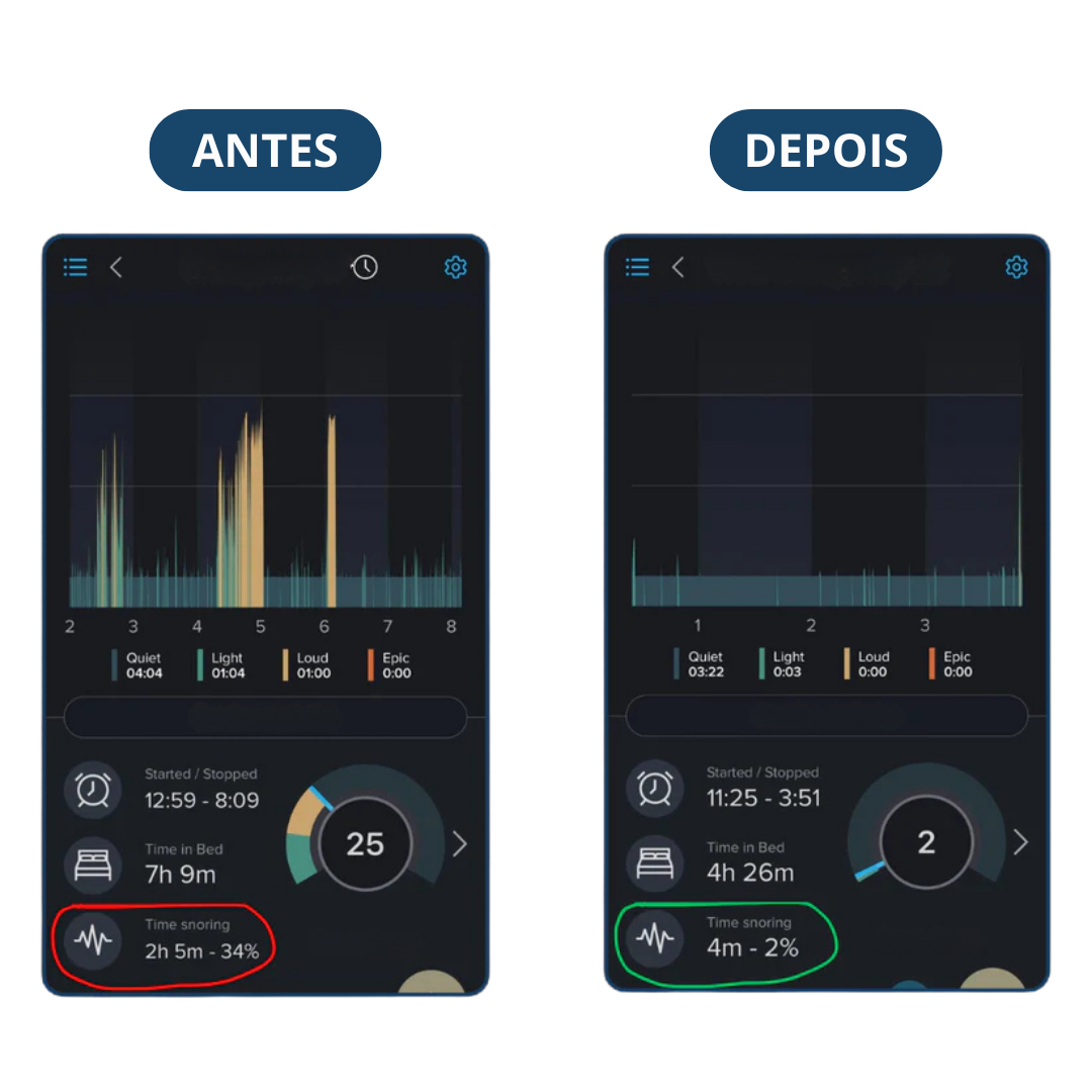 Protetor Bucal Anti-Ronco Znorex®